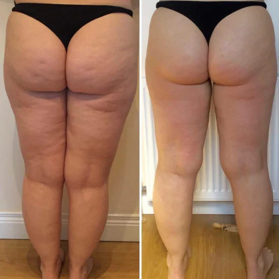Dekcan - Cellu Infrarot-Wärme-Anti-Cellulite-Gerät