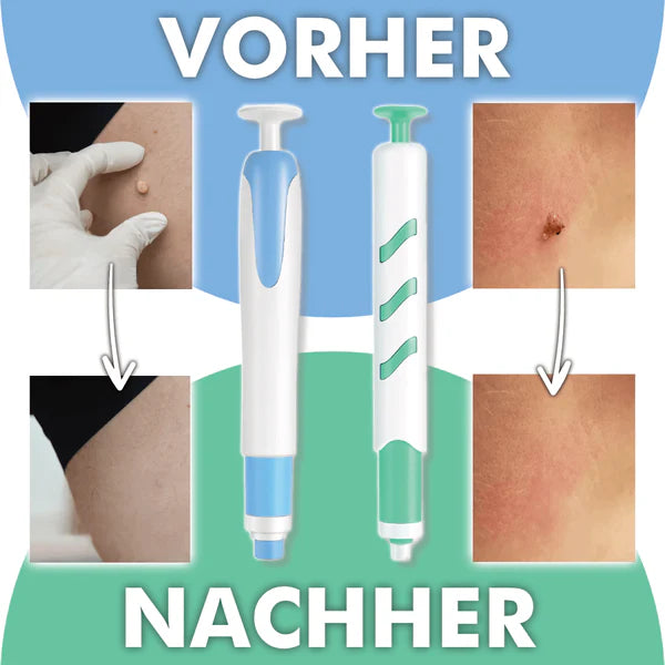 Warzenfrei   PRO   -   Der   Professionelle   Stielwarzen   Entferner
