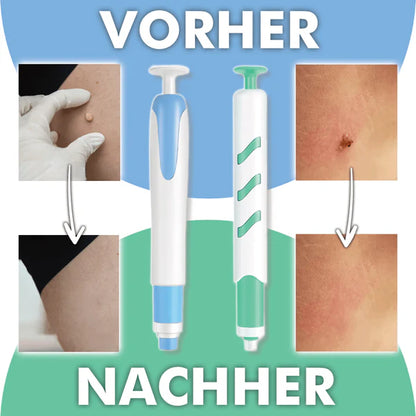 Warzenfrei   PRO   -   Der   Professionelle   Stielwarzen   Entferner