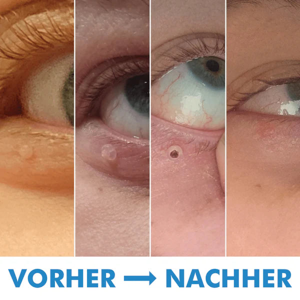 Warzenfrei   PRO   -   Der   Professionelle   Stielwarzen   Entferner