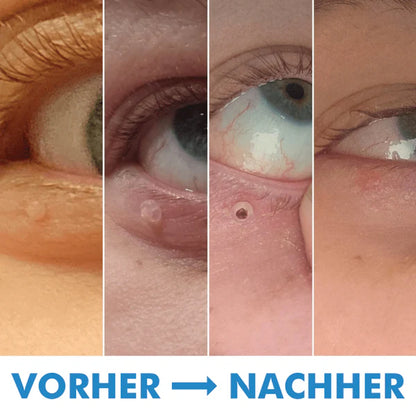 Warzenfrei   PRO   -   Der   Professionelle   Stielwarzen   Entferner