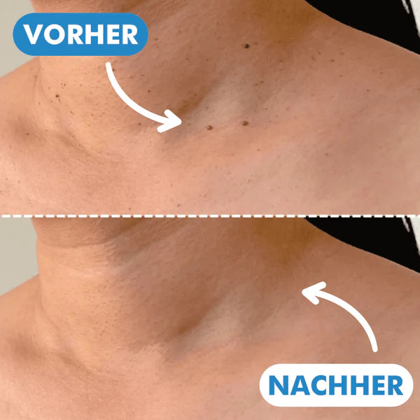 Warzenfrei   PRO   -   Der   Professionelle   Stielwarzen   Entferner